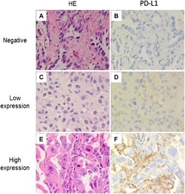 Association of Lung Adenocarcinoma Subtypes According to the IASLC/ATS/ERS Classification and Programmed Cell Death Ligand 1 (PD-L1) Expression in Tumor Cells